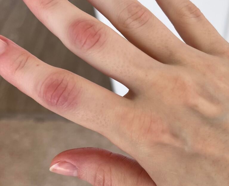 afiapro pembengkakan sendi