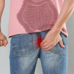 hemotera mencegah wasir secara alami