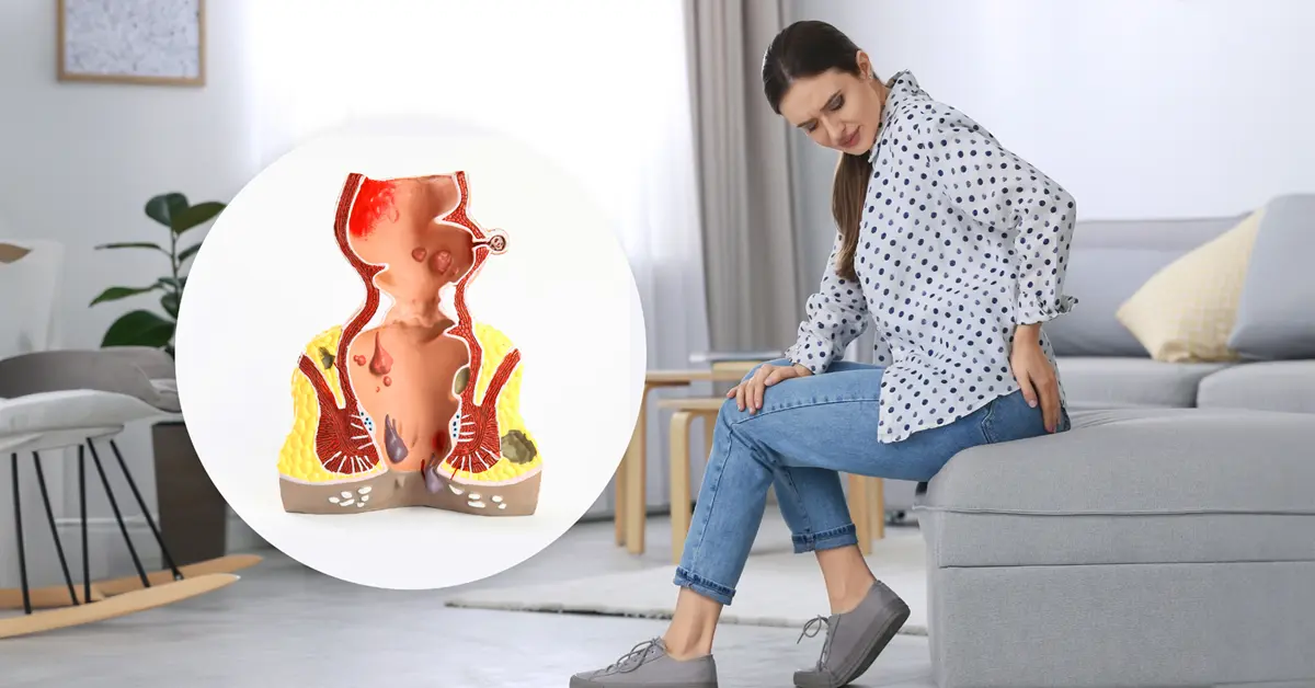 hemotera wasir terjepit