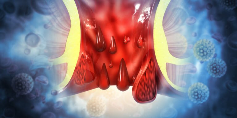hemotera wasir dan disfungsi ereksi