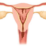 Apa Penyebab Ketidakseimbangan Hormon Pada Wanita