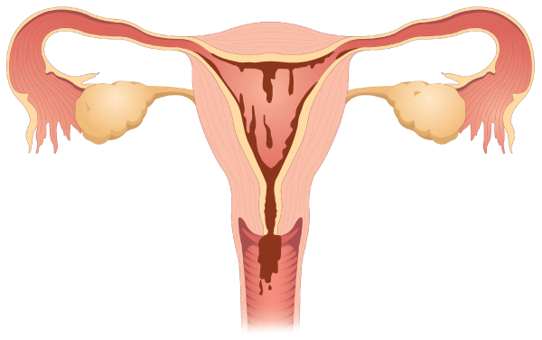 Apa Penyebab Ketidakseimbangan Hormon Pada Wanita