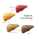 Apa yang Terjadi Jika Fungsi Hati Terganggu