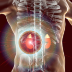 Apakah Gangguan Ginjal Menyebabkan Tekanan Darah Tinggi