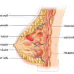 Apakah Jaringan Lemak Payudara Bisa Berkurang