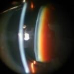 Apakah Suplemen Mata bisa Membantu Mengurangi Risiko Katarak