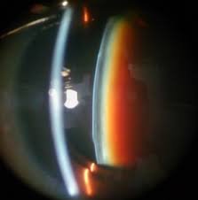 Apakah Suplemen Mata bisa Membantu Mengurangi Risiko Katarak