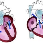 Bagaimana Cara Membaca Hasil Tensi Diastolik dan Sistolik dengan Benar