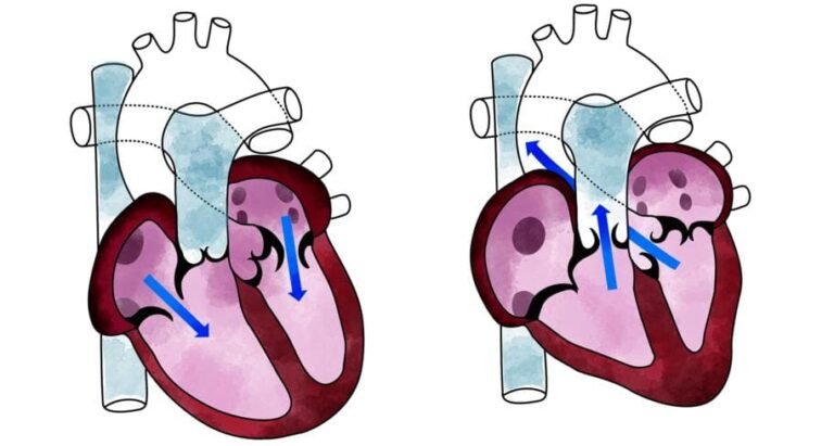 Bagaimana Cara Membaca Hasil Tensi Diastolik dan Sistolik dengan Benar