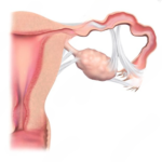 Bagaimana Cara Mengatasi Penyumbatan Tuba Falopi