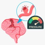 Bagaimana Mekanisme Darah Tinggi Menyebabkan Stroke