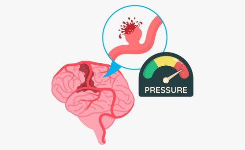 Bagaimana Mekanisme Darah Tinggi Menyebabkan Stroke