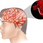 Bahaya Hipertensi Kronis terhadap Pembuluh Darah Otak