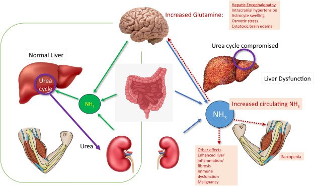 Bahaya Penumpukan Amonia Akibat Penurunan Fungsi Liver