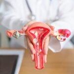 Ciri-ciri kista ovarium