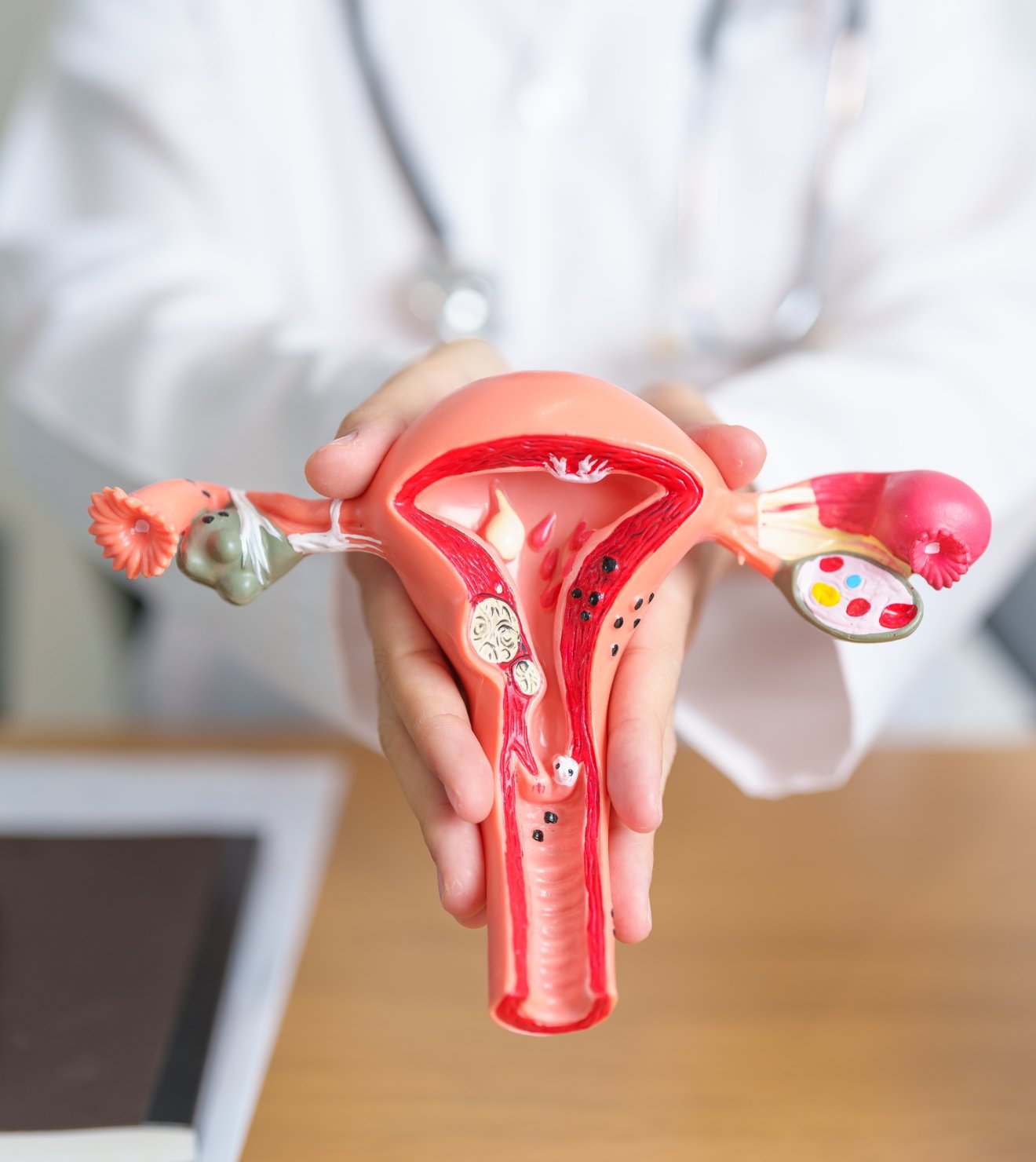 Ciri-ciri kista ovarium