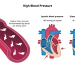 Darah Tinggi & Peradangan Pembuluh Darah Pemicu Utama Serangan Jantung