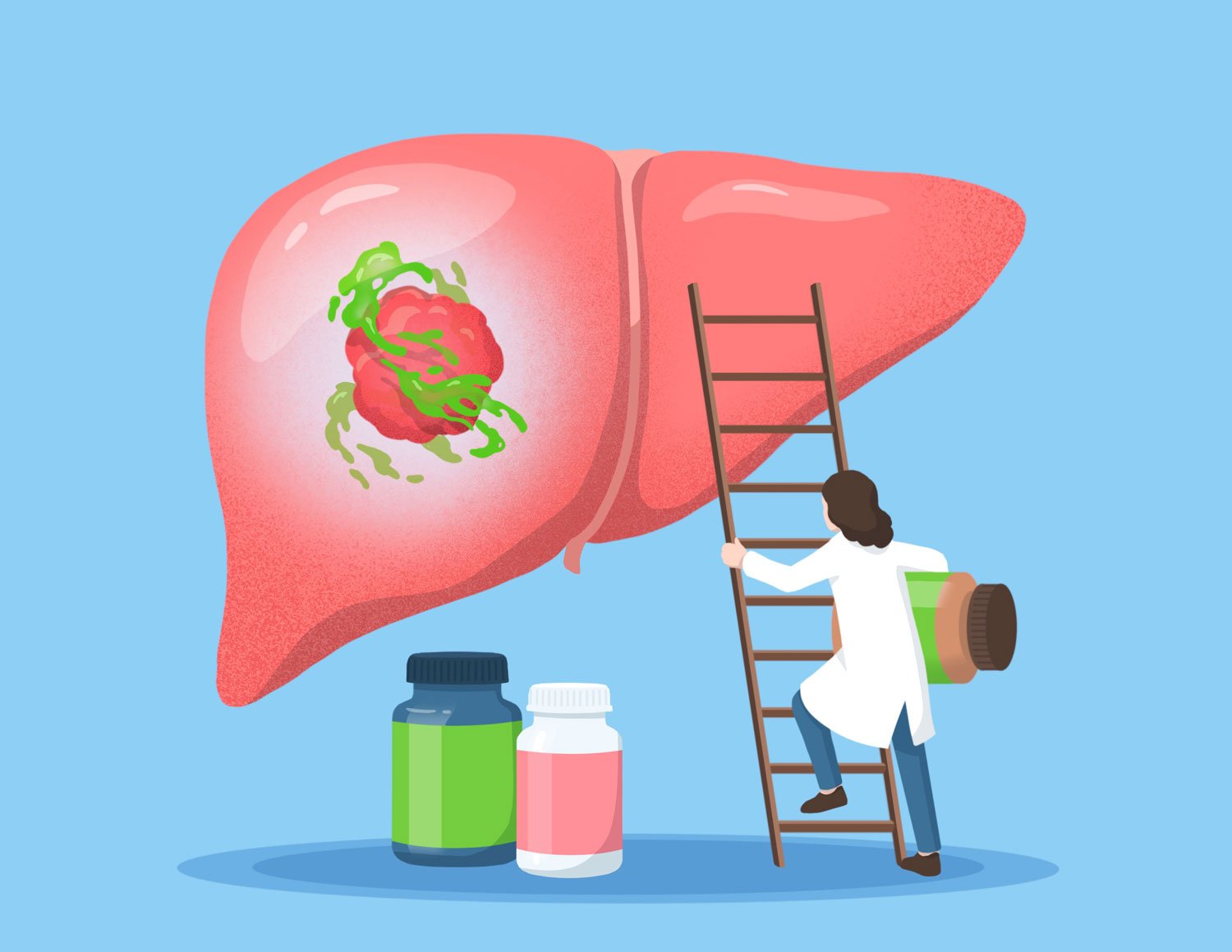 Gejala Kanker Hati Stadium Awal yang Sering Tak Disadari