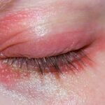 Gejala Radang Mata Kronis yang Perlu Segera di obati