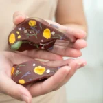 Gejala hepatitis B yang sering tidak disadari