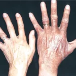 Hemokromatosis Penyakit Kelebihan Zat Besi yang Merusak Hati