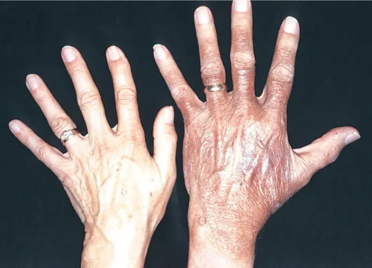 Hemokromatosis Penyakit Kelebihan Zat Besi yang Merusak Hati