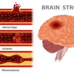 Hipertensi dan Risiko Stroke Peran Peradangan dalam Penyumbatan Otak