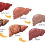 Kegagalan Hati Akut Mengapa Tubuh Bisa Keracunan Sendiri