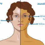 Kulit Menguning Bisa Jadi Tanda Penyakit Hati