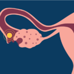 Masa subur wanita menjadi lebih mudah diprediksi melalui perubahan suhu tubuh