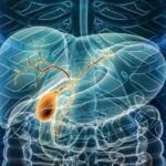 Mengenal Kolestasis, Gangguan Aliran Cairan Empedu dari Hati