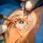 Penanganan Katarak pada Penderita Diabetes