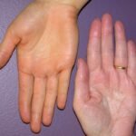 Penyakit Kuning (Jaundice) Sebagai Tanda Hati Gagal Berfungsi