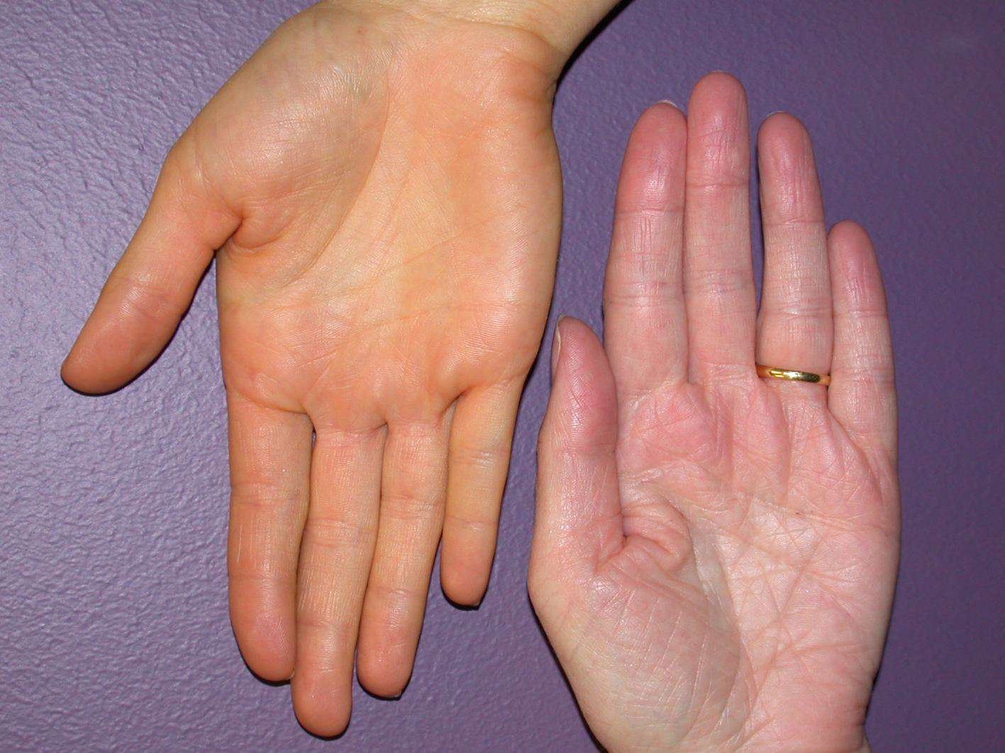 Penyakit Kuning (Jaundice) Sebagai Tanda Hati Gagal Berfungsi