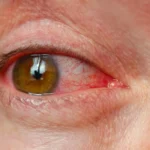 Penyebab Mata Merah dan Bengkak Bahaya Radang Mata yang Wajib Diwaspadai