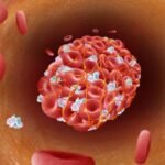 Penyumbatan Pembuluh Darah Dampak Ngeri Tekanan Darah Tinggi yang Tak Terkontrol