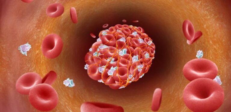 Penyumbatan Pembuluh Darah Dampak Ngeri Tekanan Darah Tinggi yang Tak Terkontrol