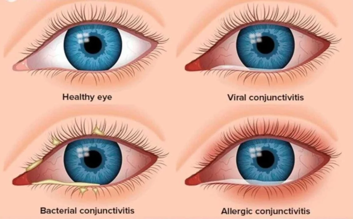 Perbedaan Radang Mata Akibat Virus dan Bakteri Mana yang Lebih Berbahaya
