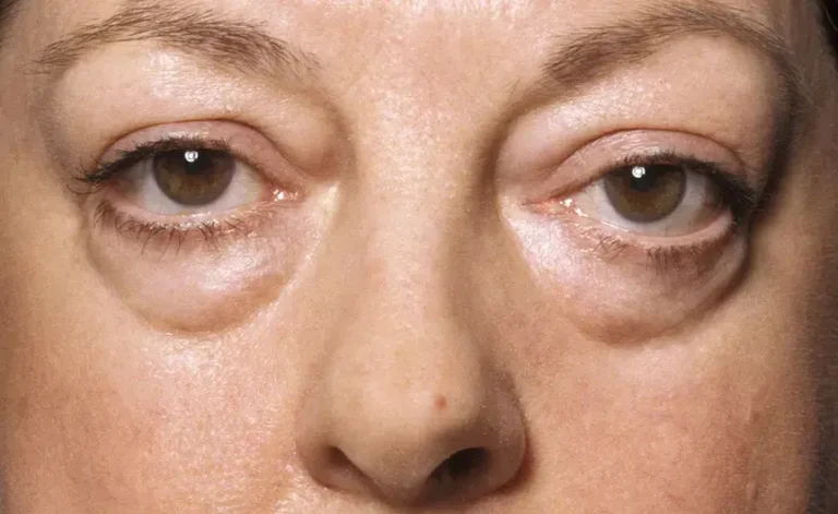 Tips Mengatasi Mata Panda dengan Cepat