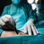 Prosedur Transplantasi Hati: Solusi Terakhir untuk Gagal Hati Kronis