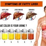 Waspada! Gejala Awal Perlemakan Hati yang Sering Diabaikan