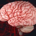 Waspada Pecah Pembuluh Darah Otak Akibat Hipertensi yang Tidak Terkontrol