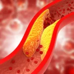 afiapro kolesterol berlebih