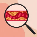 afiapro penyebab kolesterol naik