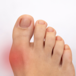 afiapro jempol kaki bengkak