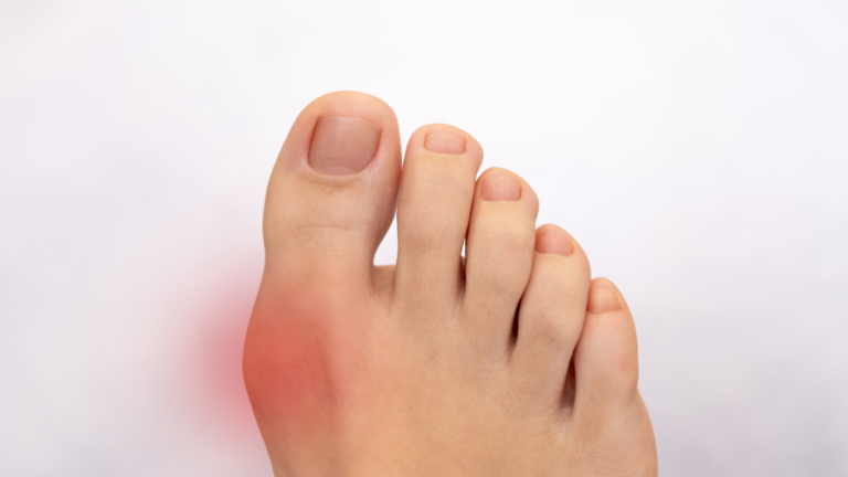 afiapro jempol kaki bengkak