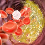 afiapro kolesterol yang tidak terkontrol