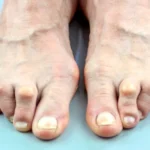 afiapro pembengkakan kaki