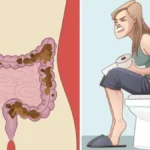 hemotera Sembelit dan BAB Keras