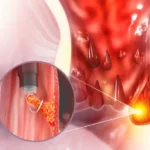 hemotera trombosis wasir luar